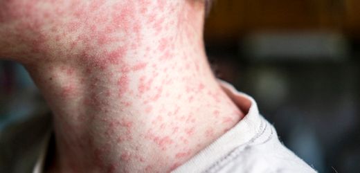 Masern: Das müssen Sie über die Infektionskrankheit wissen