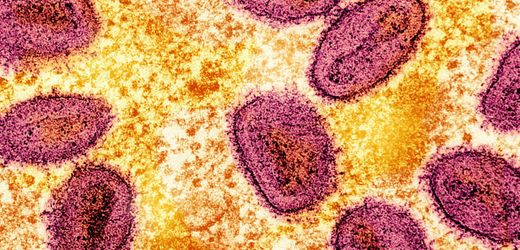 Mpox: Experten warnen vor ernster Bedrohung durch Affenpocken