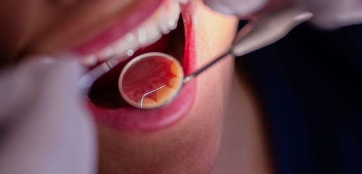 Zahngesundheit: Immer mehr Deutsche sind kariesfrei