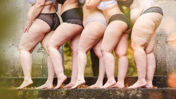 Junge Velberterin kämpft um Spenden für lebensverändernde OP