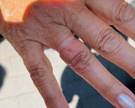 Einsatz der filigranen Art: Ehering sitzt fest – Feuerwehr Jüchen rettet Dame bei Finger-Schwellung
