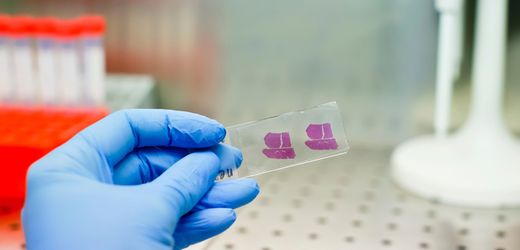 Leberkrebs: Mediziner erwarten deutlich mehr Fälle bis zum Jahr 2050