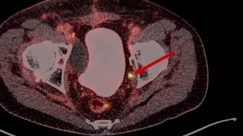 „Tastuntersuchung ist Medizin-Geschichte“: Neue Diagnostikverfahren bei Prostata-Krebs