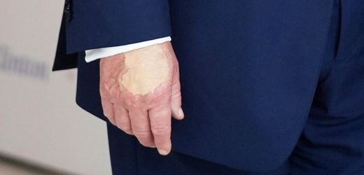 Donald Trump: Weißes Haus erklärt Fleck an rechter Hand des Präsidenten
