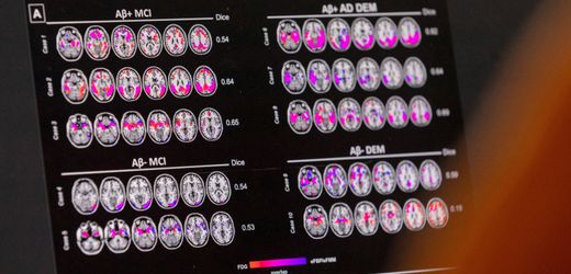 Wegovy: Test von Diabetes-Mittel gegen Alzheimer verläuft enttäuschend