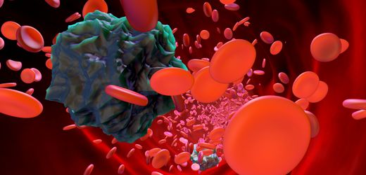 Leukämie: Gentherapie hilft einigen Patienten offenbar gegen unheilbaren Blutkrebs