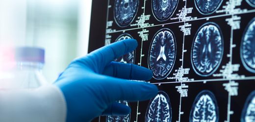 Gürtelrose-Vakzin: Ist diese Impfung eine Therapie gegen Demenz?