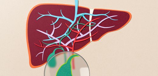 Gallenkoliken, Gallenblase, Gallensteine: »Das sind vernichtende Schmerzen«