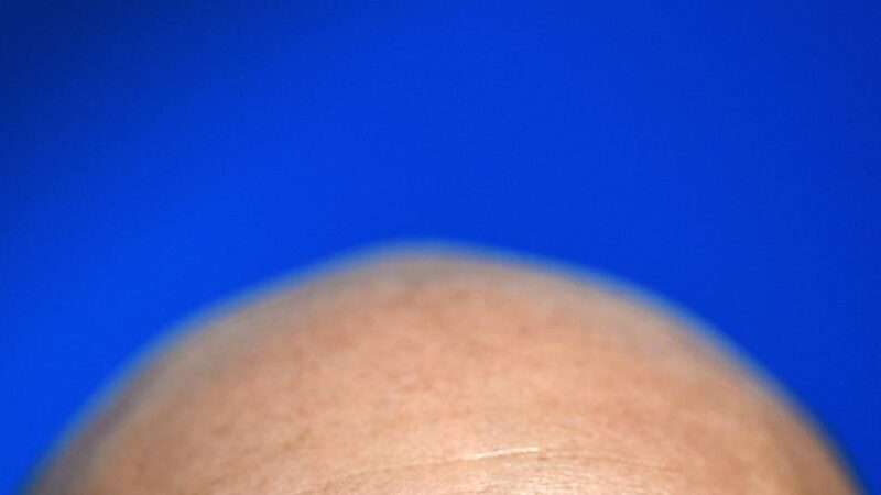 Kolumne Iss dich gesund: Wie Vitamine gegen Haarausfall helfen