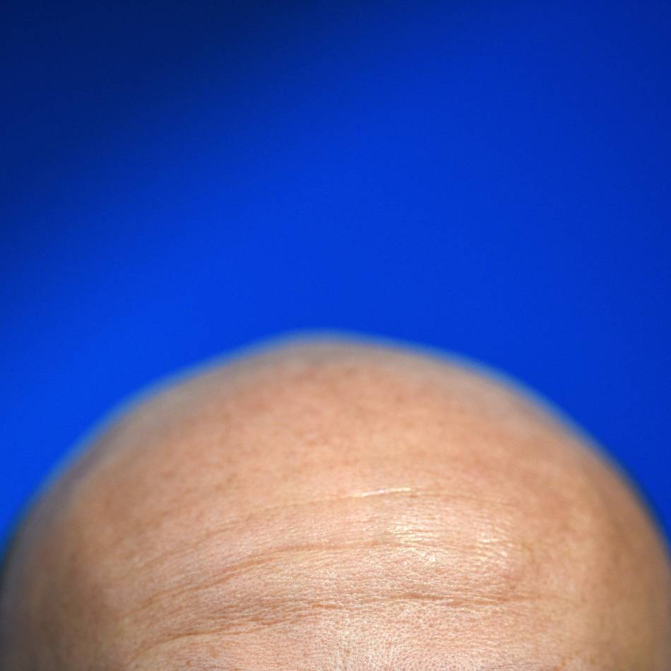 Kolumne Iss dich gesund: Wie Vitamine gegen Haarausfall helfen