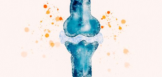 Rheuma: Was (besonders) Frauen wissen sollten