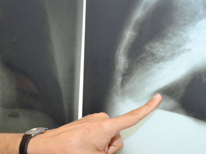 Helios-Klinik in Wipperfürth: Ziel: Lungenkrebs frühzeitig erkennen