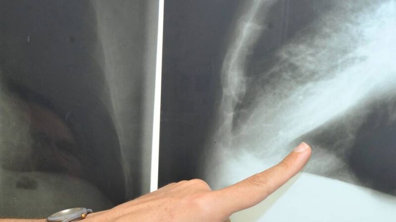 Helios-Klinik in Wipperfürth: Ziel: Lungenkrebs frühzeitig erkennen