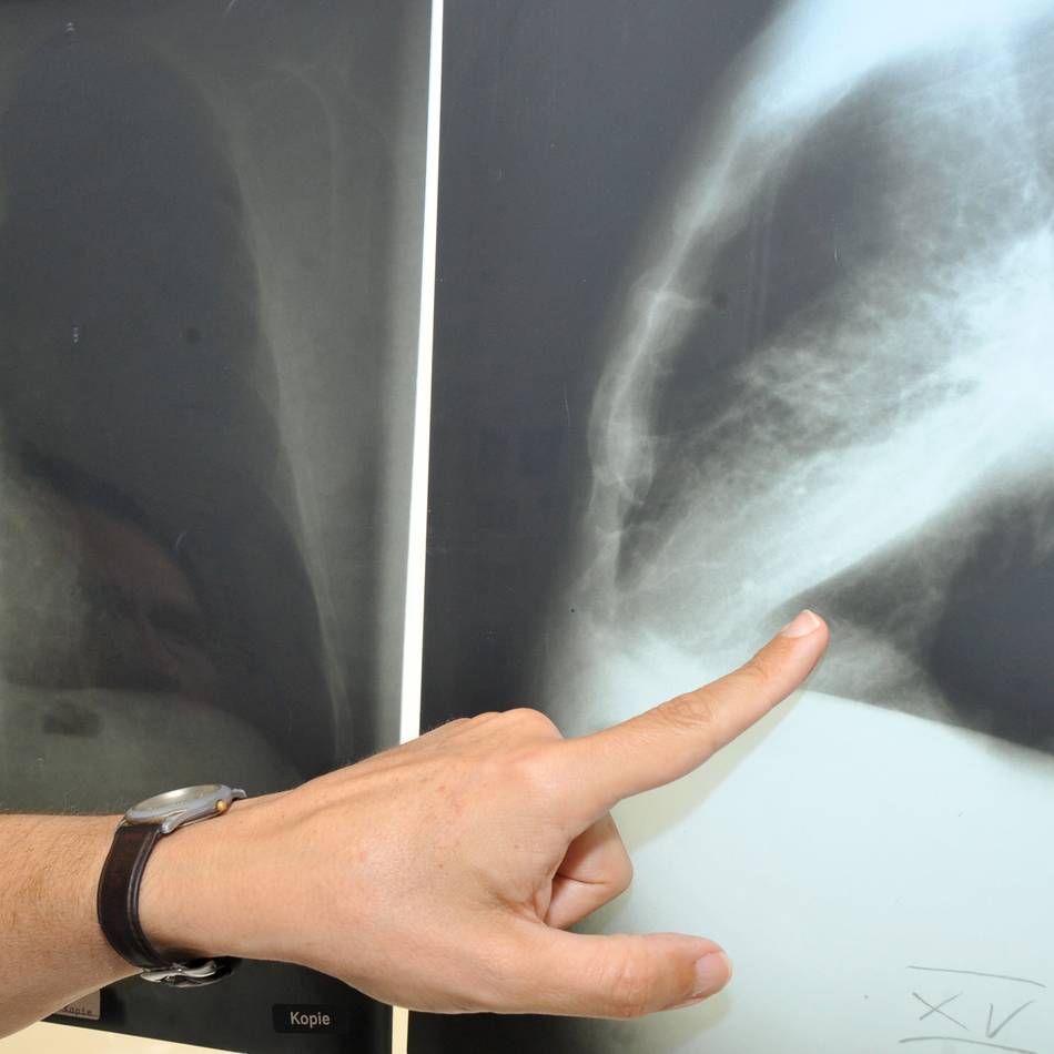 Helios-Klinik in Wipperfürth: Ziel: Lungenkrebs frühzeitig erkennen