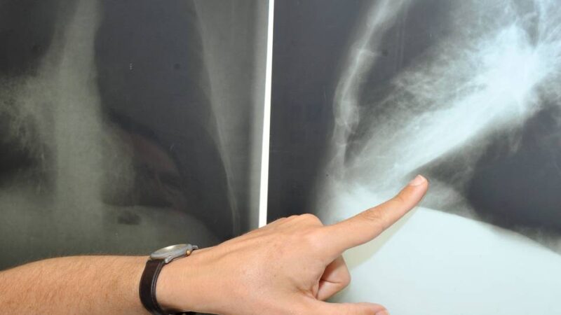 Änderung für Raucher in Krefeld: So funktioniert die neue Früherkennung von Lungenkrebs