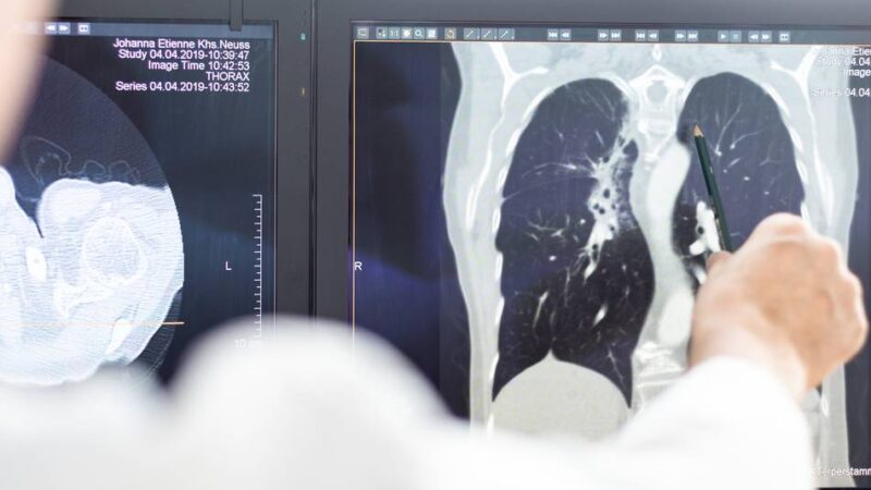 Auszeichnung für Johanna-Etienne-Krankenhaus: Neusser Klinik wird Kompetenzzentrum für Thoraxchirurgie